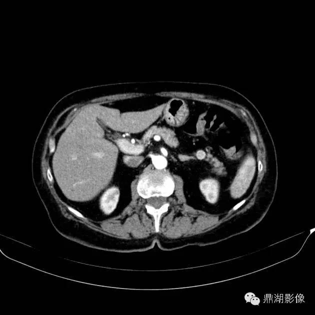 【病例】胰腺异位副脾1例CT 【病例】胰腺异位副脾1例CT