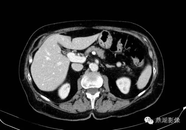 【病例】胰腺异位副脾1例CT