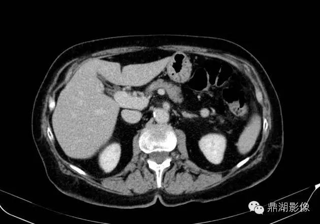 【病例】胰腺异位副脾1例CT 【病例】胰腺异位副脾1例CT