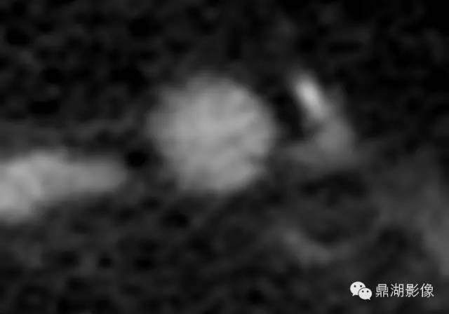 【病例】胰腺异位副脾1例CT 【病例】胰腺异位副脾1例CT