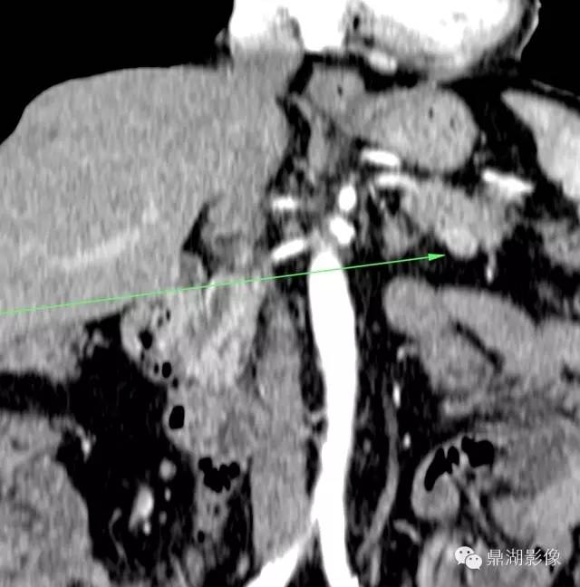 【病例】胰腺异位副脾1例CT 【病例】胰腺异位副脾1例CT
