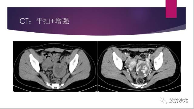 【病例】左侧残角子宫妊娠1例CT影像表现