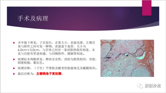 【病例】左侧残角子宫妊娠1例CT影像表现