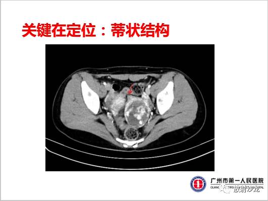 【病例】左侧残角子宫妊娠1例CT影像表现