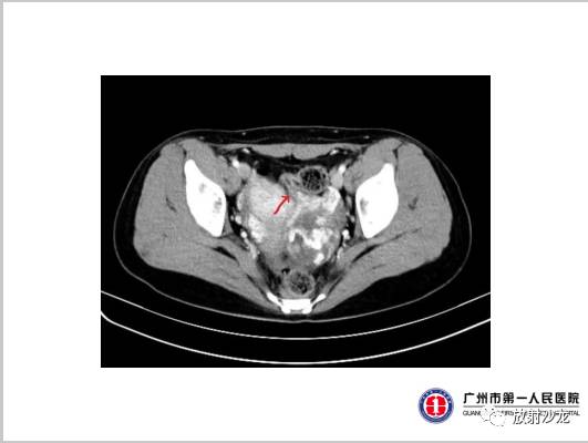 【病例】左侧残角子宫妊娠1例CT影像表现