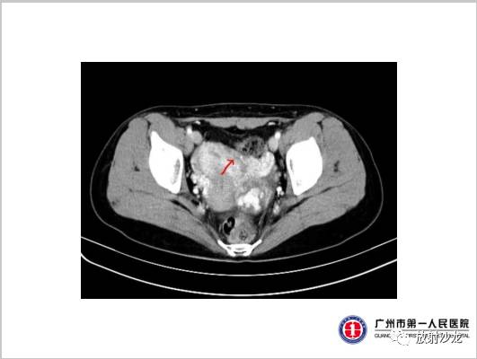 【病例】左侧残角子宫妊娠1例CT影像表现