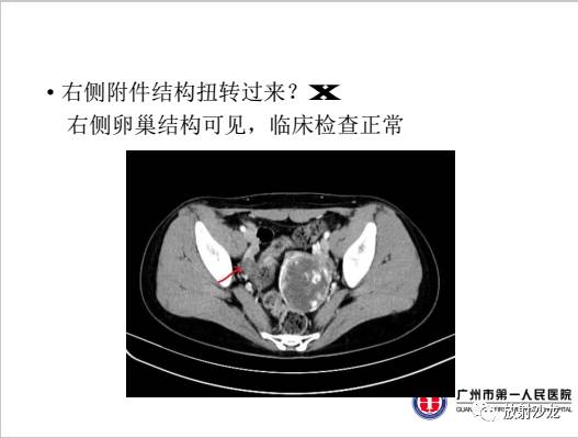 【病例】左侧残角子宫妊娠1例CT影像表现