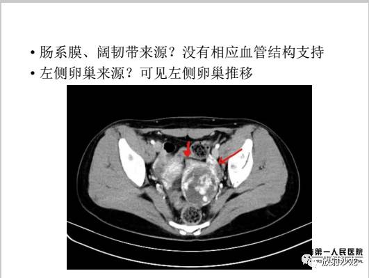 【病例】左侧残角子宫妊娠1例CT影像表现