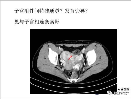 【病例】左侧残角子宫妊娠1例CT影像表现