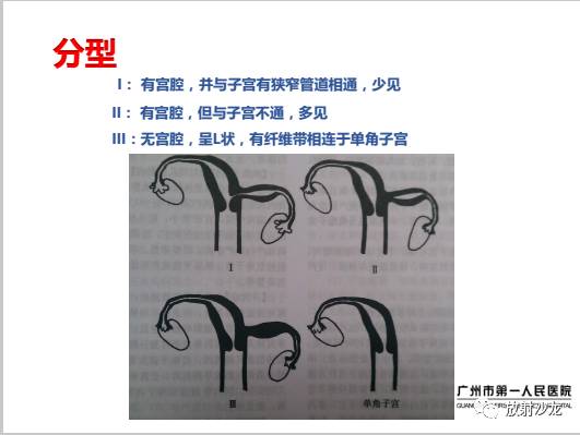 【病例】左侧残角子宫妊娠1例CT影像表现