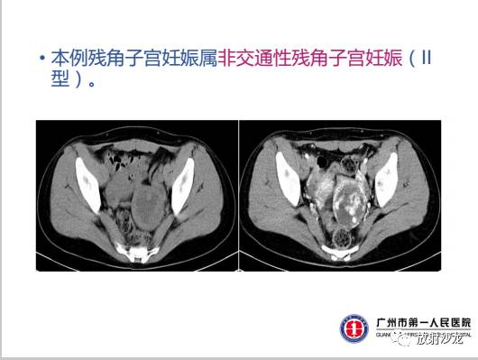 【病例】左侧残角子宫妊娠1例CT影像表现