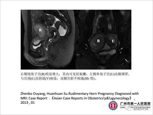 【病例】左侧残角子宫妊娠1例CT影像表现