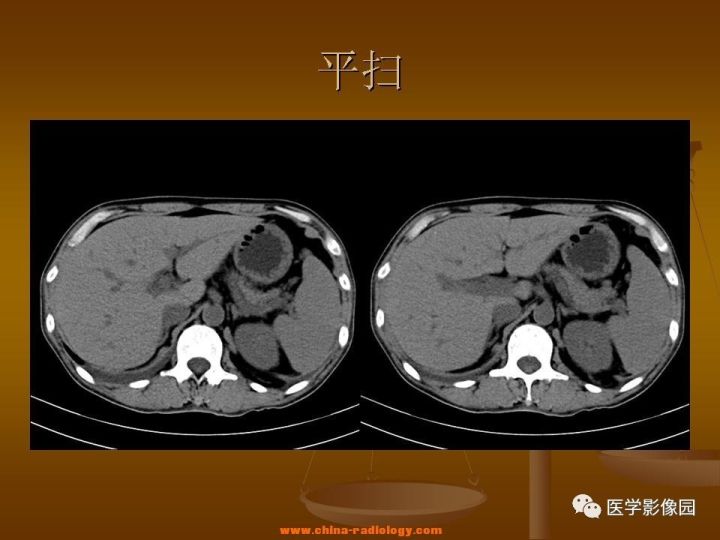 【病例】结肠粘液腺癌1例CT影像表现