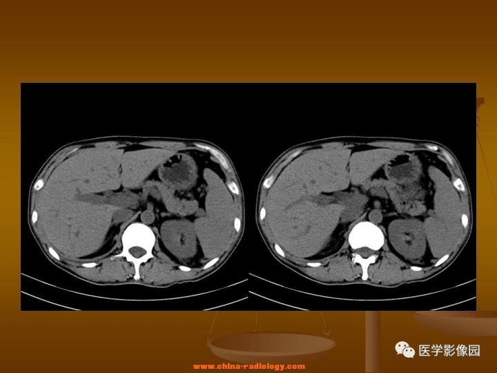 【病例】结肠粘液腺癌1例CT影像表现