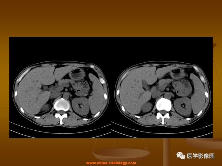 【病例】结肠粘液腺癌1例CT影像表现