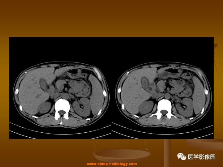 【病例】结肠粘液腺癌1例CT影像表现