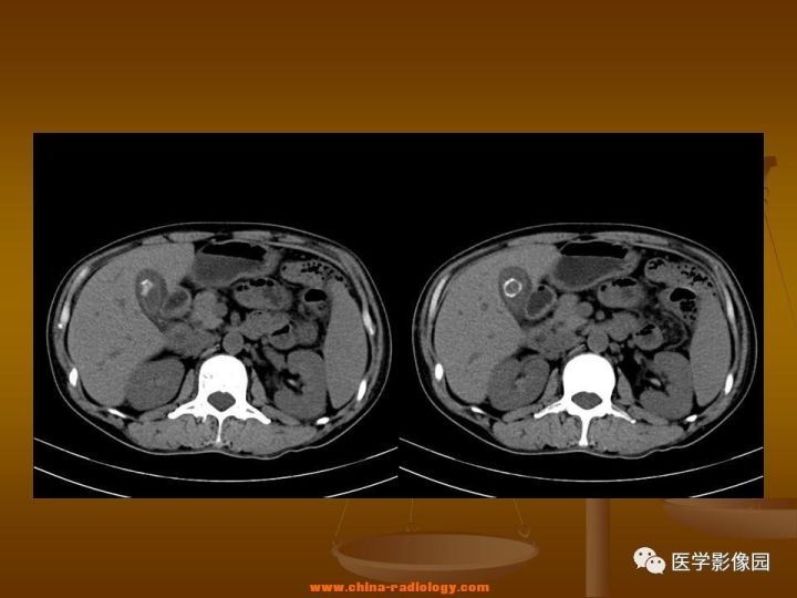 【病例】结肠粘液腺癌1例CT影像表现