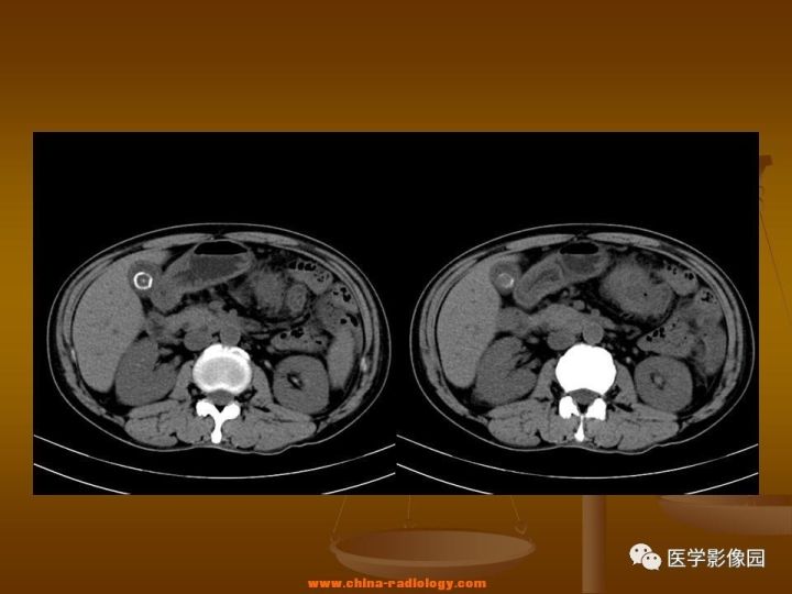 【病例】结肠粘液腺癌1例CT影像表现