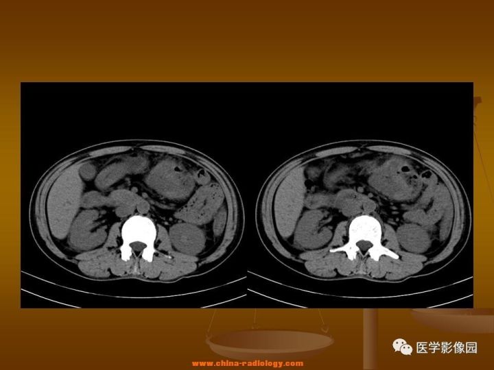 【病例】结肠粘液腺癌1例CT影像表现