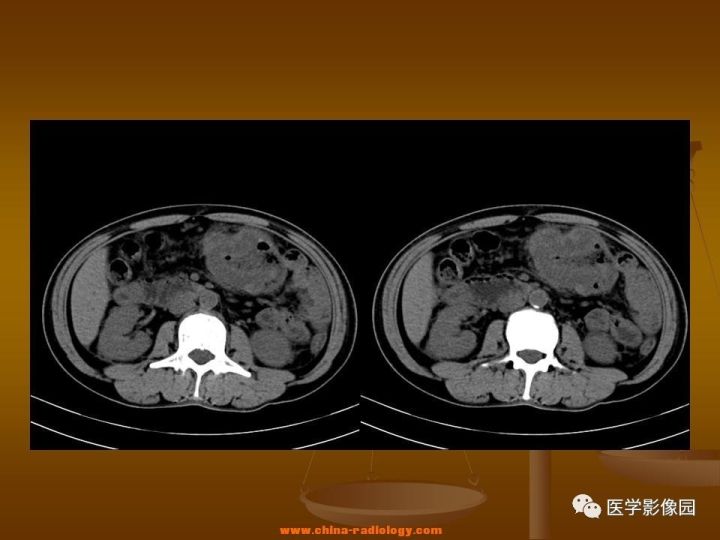 【病例】结肠粘液腺癌1例CT影像表现