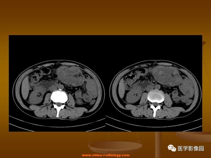 【病例】结肠粘液腺癌1例CT影像表现