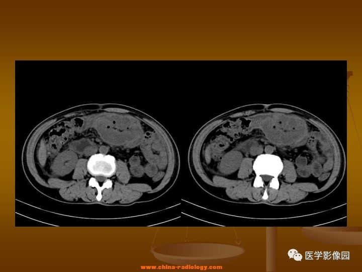 【病例】结肠粘液腺癌1例CT影像表现