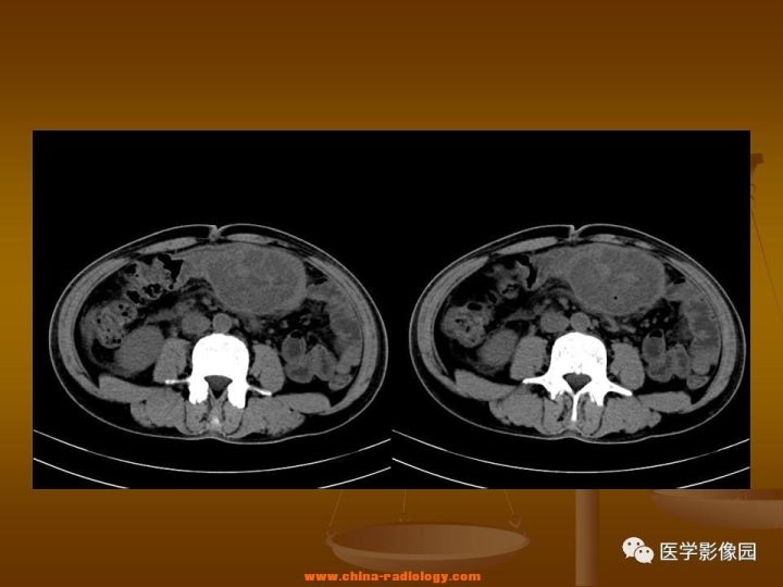 【病例】结肠粘液腺癌1例CT影像表现