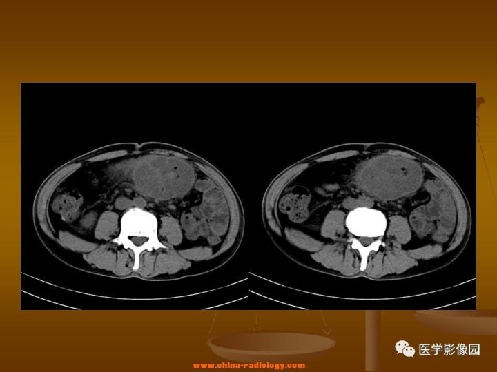 【病例】结肠粘液腺癌1例CT影像表现