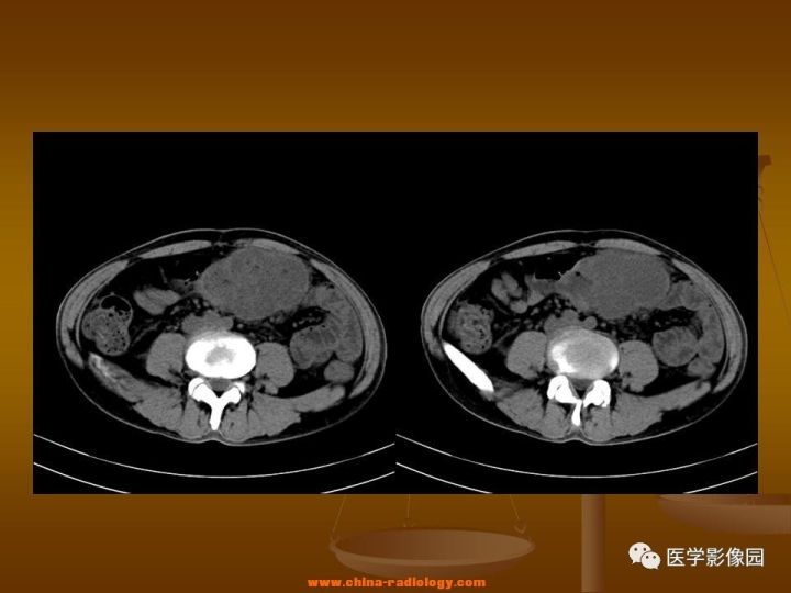 【病例】结肠粘液腺癌1例CT影像表现