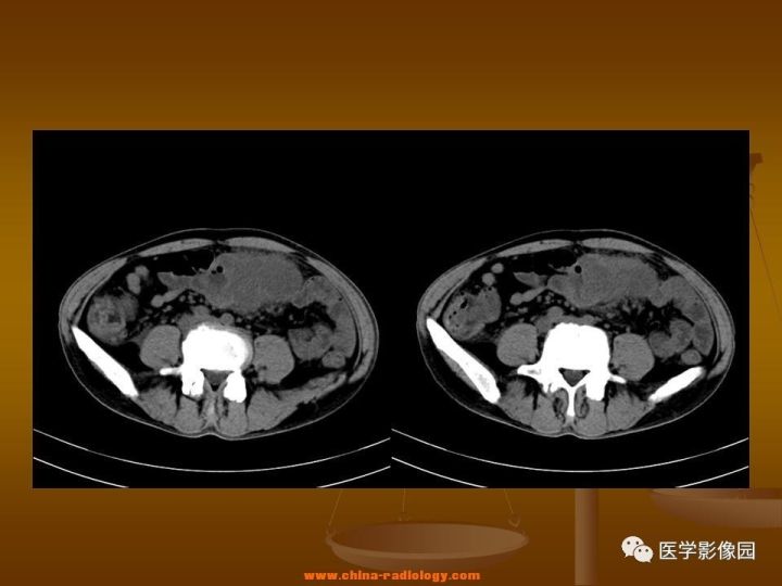 【病例】结肠粘液腺癌1例CT影像表现