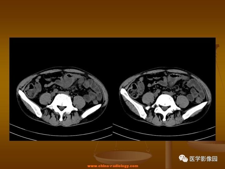 【病例】结肠粘液腺癌1例CT影像表现