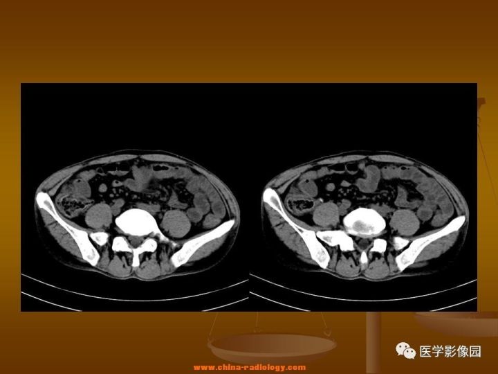 【病例】结肠粘液腺癌1例CT影像表现