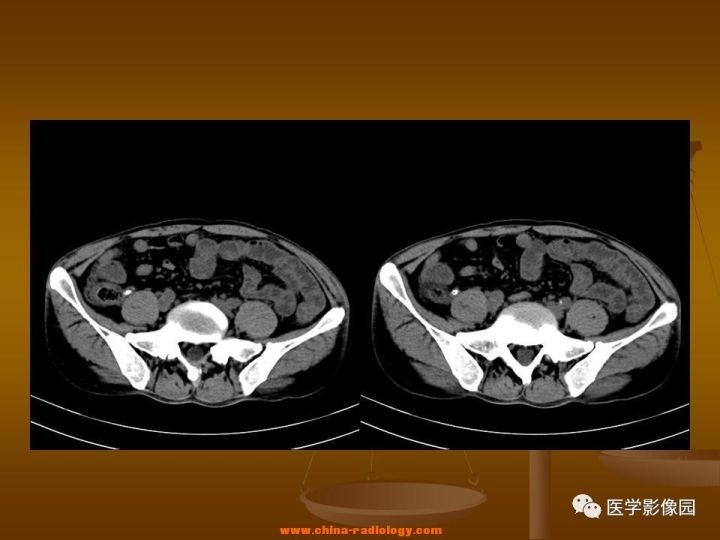 【病例】结肠粘液腺癌1例CT影像表现