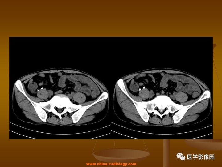 【病例】结肠粘液腺癌1例CT影像表现