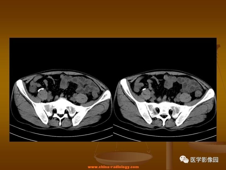【病例】结肠粘液腺癌1例CT影像表现