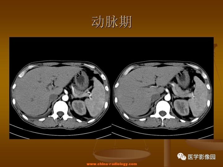【病例】结肠粘液腺癌1例CT影像表现