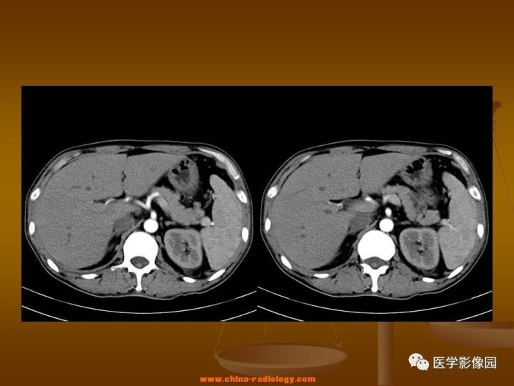 【病例】结肠粘液腺癌1例CT影像表现