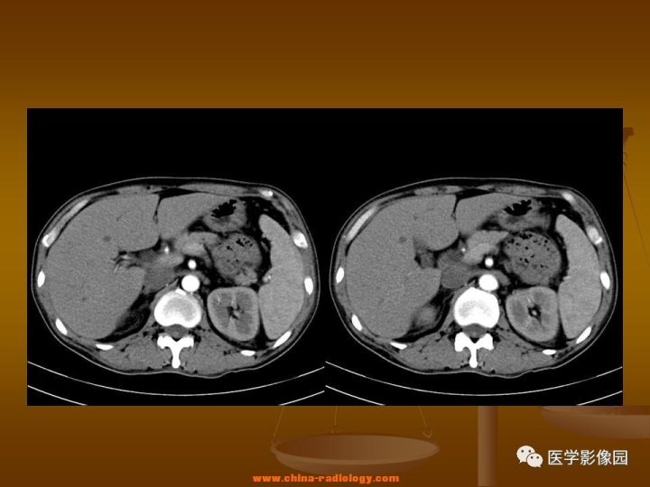 【病例】结肠粘液腺癌1例CT影像表现