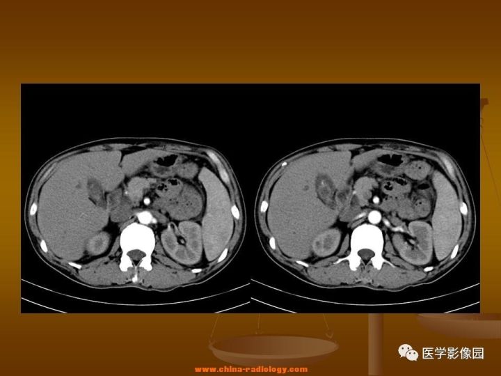 【病例】结肠粘液腺癌1例CT影像表现