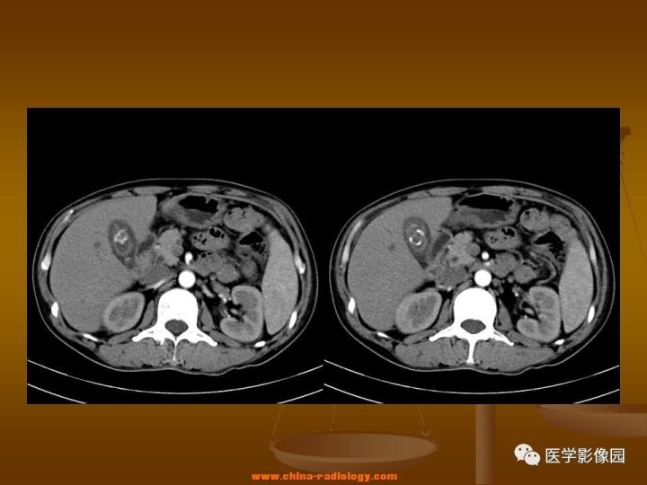 【病例】结肠粘液腺癌1例CT影像表现