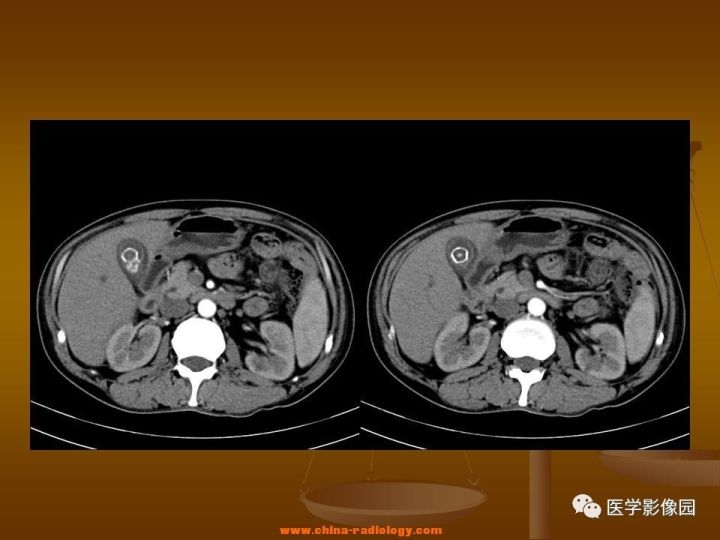 【病例】结肠粘液腺癌1例CT影像表现
