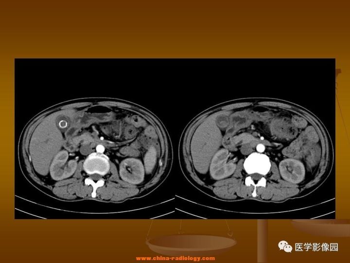 【病例】结肠粘液腺癌1例CT影像表现