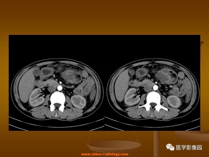 【病例】结肠粘液腺癌1例CT影像表现