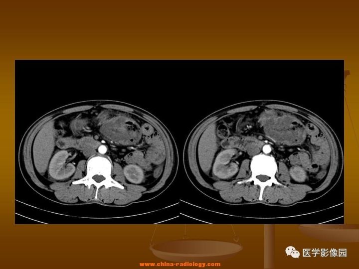 【病例】结肠粘液腺癌1例CT影像表现