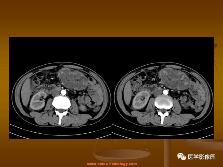 【病例】结肠粘液腺癌1例CT影像表现