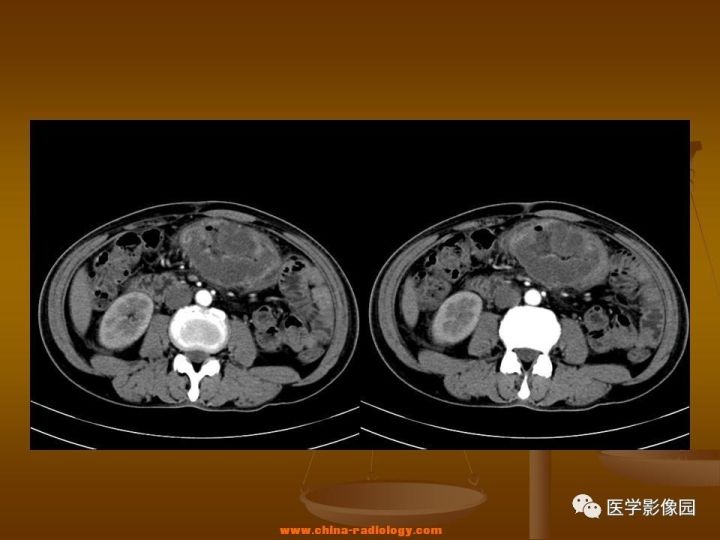 【病例】结肠粘液腺癌1例CT影像表现