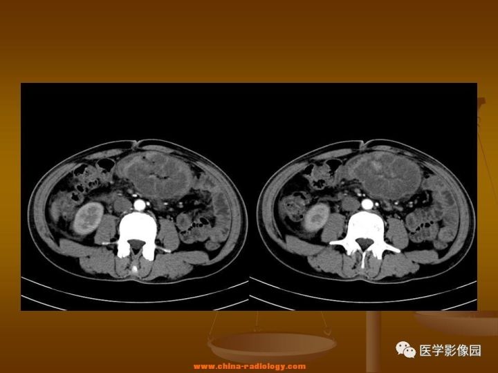 【病例】结肠粘液腺癌1例CT影像表现