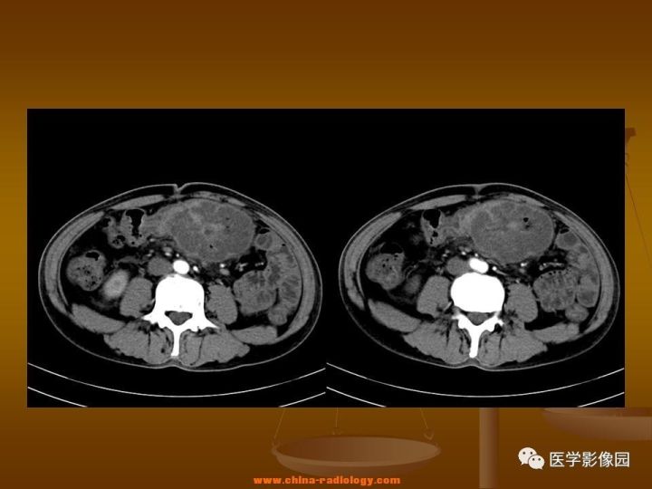 【病例】结肠粘液腺癌1例CT影像表现