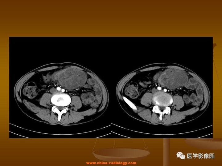【病例】结肠粘液腺癌1例CT影像表现