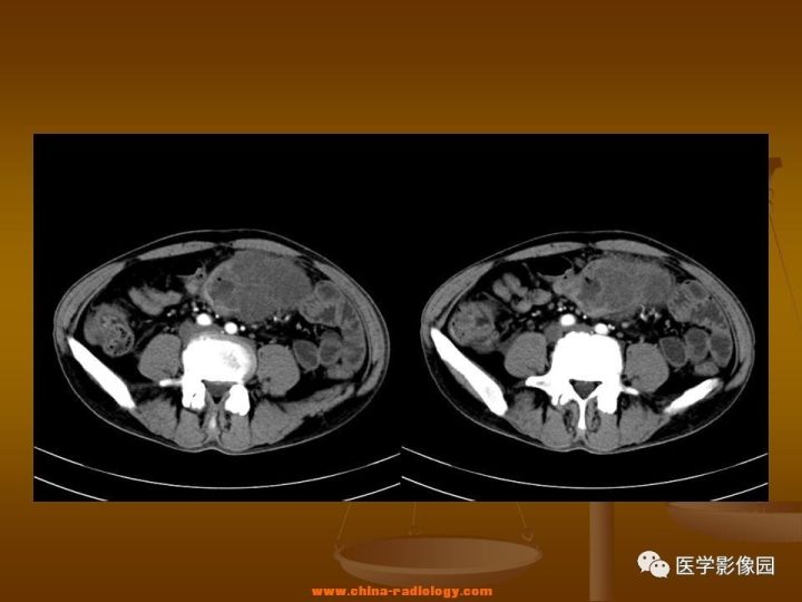【病例】结肠粘液腺癌1例CT影像表现